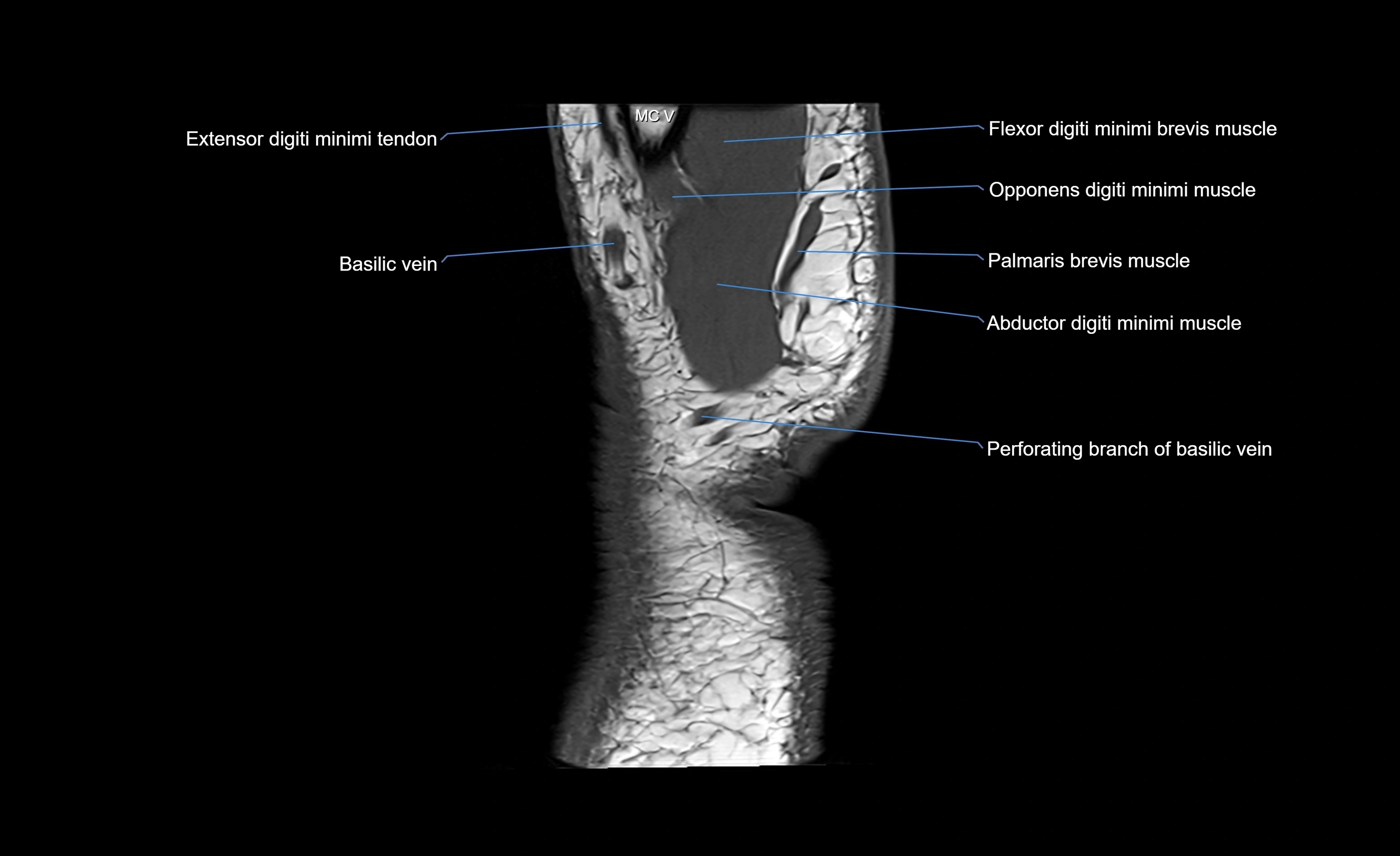 MRI wrist sagittal cross sectional anatomy 3T  radiology  image-img-00001-00026.webp
